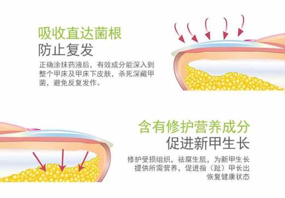 灰指甲修复的原理是什么-图2