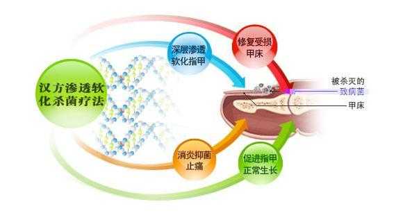 灰指甲修复的原理是什么-图3