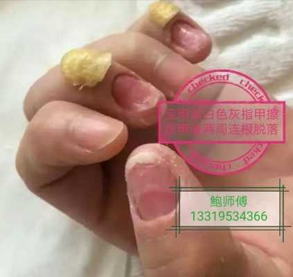 灰指甲怎么样修复甲床图片,灰指甲甲床如何修复 -图2