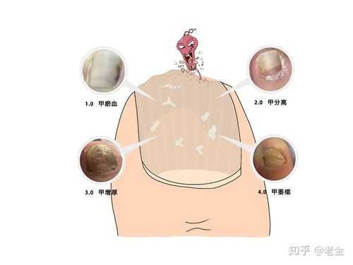 真菌感染指甲修复多久（真菌感染指甲修复多久可以恢复）-图3