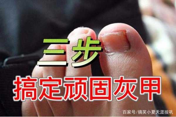  灰指甲修复后还会复发吗「灰指甲修完多久能长出来」-图2