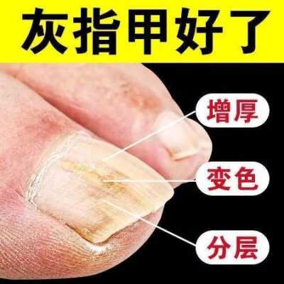 修复指甲划痕用什么药好,指甲 修复 -图1