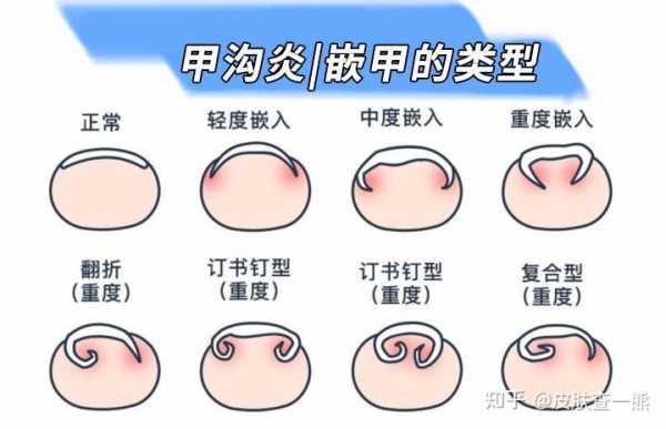 灰指甲甲沟炎修复及护理（灰指甲甲沟炎怎么办）-图2