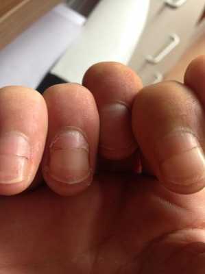 甲床受损长出的指甲很厚怎么办 甲床受损指甲长的凹凸怎么修复-图3
