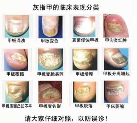 灰指甲里面是啥 灰指甲最里面分层怎么修复-图2