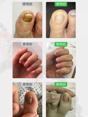 修复灰指甲用泡水吗_灰指甲修复液可以直接抹在皮肤上吗-图3