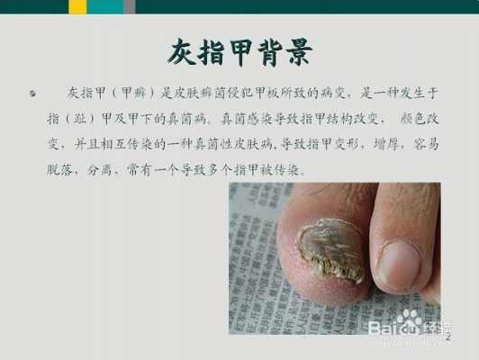 百度那些修复灰指甲的靠谱吗,百度治疗灰指甲 -图2