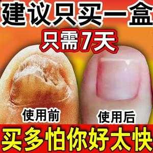 受损的指甲怎么保养 指甲受损修复用什么药膏-图2