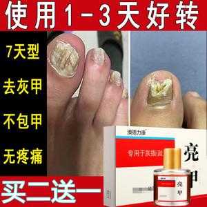 指甲变厚用什么药膏好 指甲厚了用什么修复快些-图2