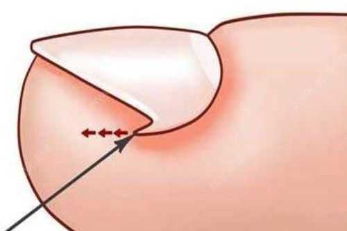 指甲嵌进肉里怎么剪-指甲嵌肉修复视频-图3