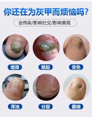 指甲抑菌液一天用几次 指甲修复抑菌液迈瑞普可以用吗-图1