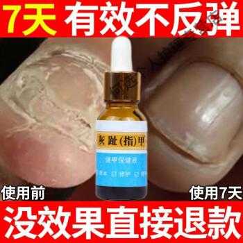 甲沟肌修复液能治灰指甲吗怎么用-图1