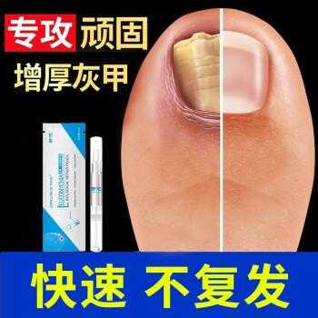 修复脚指甲液怎么用的视频（脚趾甲护理液有用吗）-图2