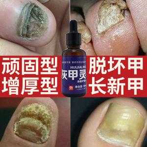 烂脚指甲修复_烂脚指甲用什么药好-图1