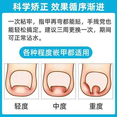 剪指甲矫正多少钱-图2