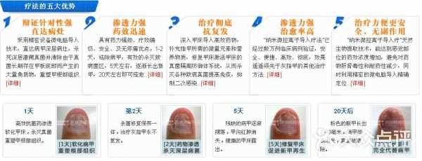  修复灰指甲的步骤「修复灰指甲费用是多少」-图3