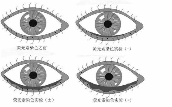 角膜染色是用什么染料-图1