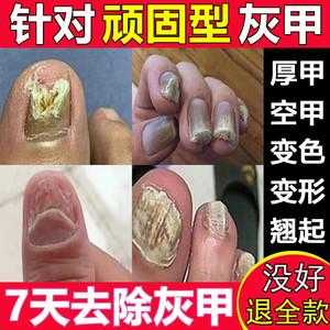 趾甲修复液-脚指甲凹陷修复霜多少钱-图3