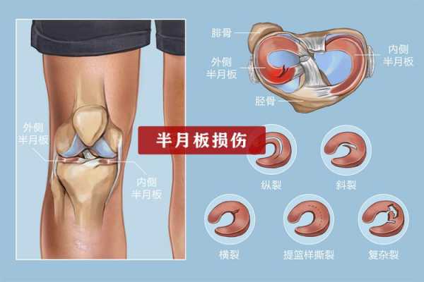 手指半月板损伤 指甲半月板磨损修复要多久-图2