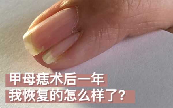 指甲病变修复手术费用多少钱-图2