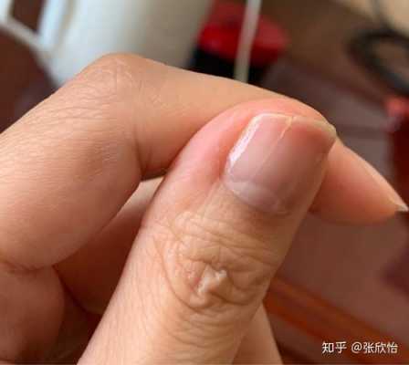 指甲竖纹裂了怎么办-指甲竖纹裂开怎么修复视频-图3