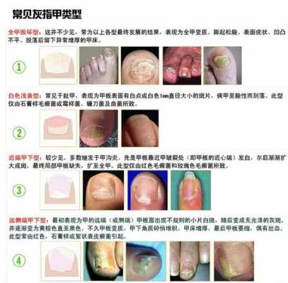 灰指甲修复测评视频-灰指甲修复测评-图1