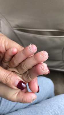 啃手指指甲已经很丑了还可以恢复吗? 啃的指甲还能修复回来吗-图2