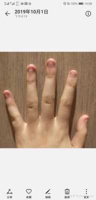 啃手指指甲已经很丑了还可以恢复吗? 啃的指甲还能修复回来吗-图3