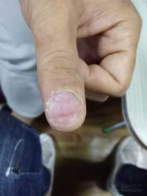 修复指甲的药膏 修复指甲的危害图片男士-图1