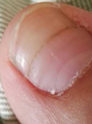 指甲上裂缝是怎么回事-指甲上的裂缝能修复吗图片-图2
