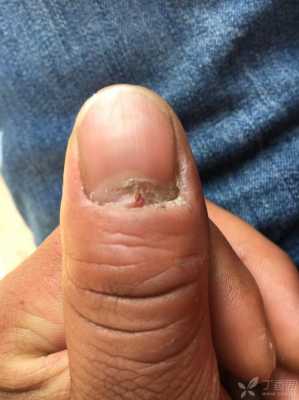 指甲被夹后裂开修复要多久-指甲被夹后裂开修复-图2