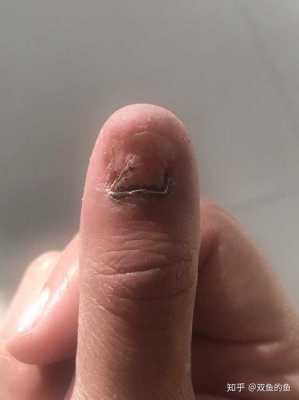 指甲被夹后裂开修复要多久-指甲被夹后裂开修复-图3