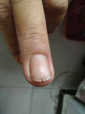 指甲很容易开裂是什么原因-图1