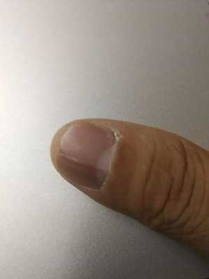 指甲很容易开裂是什么原因-图2