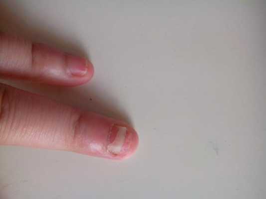 指甲损坏多年能修复吗-图2