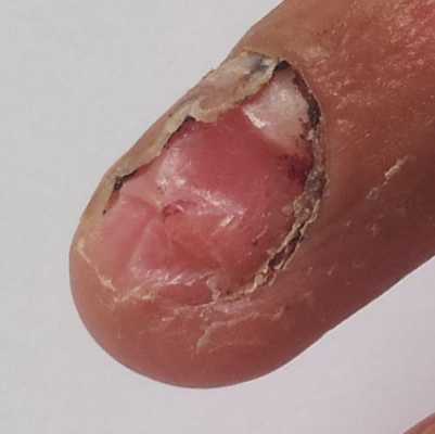 指甲损坏多年能修复吗-图3