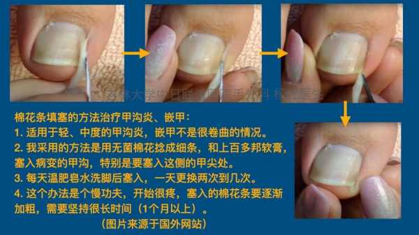 指甲没有甲沟可以修复吗（指甲没嵌在肉里的甲沟炎怎么治疗）-图1