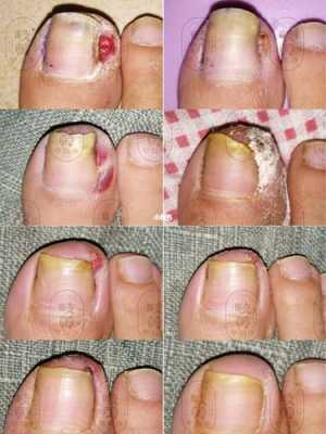 指甲没有甲沟可以修复吗（指甲没嵌在肉里的甲沟炎怎么治疗）-图2