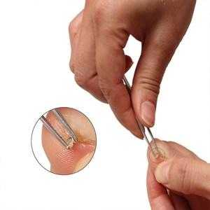 镊子宽指甲变窄修复手术,指甲短宽整形 -图1