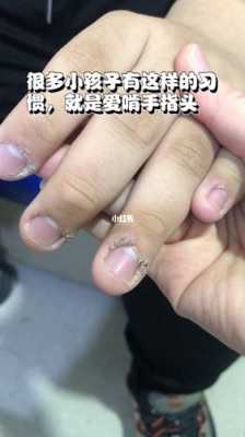 咬指甲周围的表皮怎么修复视频-图3