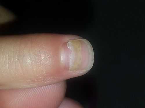 指甲盖脱落前兆-指甲盖脱了怎么修复-图1