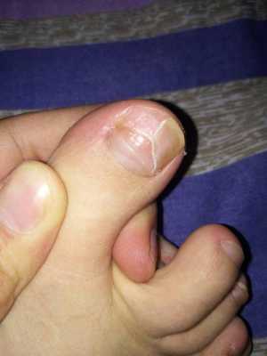指甲盖脱落前兆-指甲盖脱了怎么修复-图3