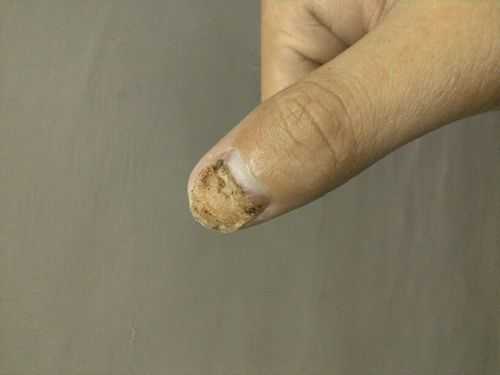 受伤指甲盖修复_受伤指甲盖修复要多久-图1