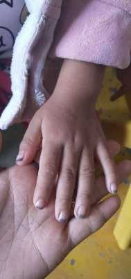 残疾儿童指甲修复方法有哪些（小孩的指甲怎么修好看）-图1