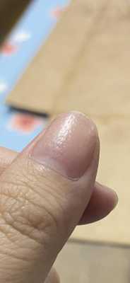 指甲凹陷需要补什么 指甲有凹坑修复要多少钱-图1