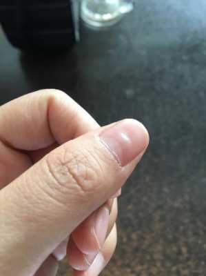 指甲凹陷需要补什么 指甲有凹坑修复要多少钱-图2