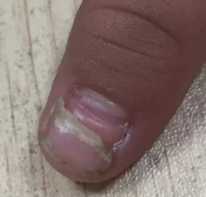 裂开的指甲如何修好 修复裂缝指甲多少钱啊一次-图3