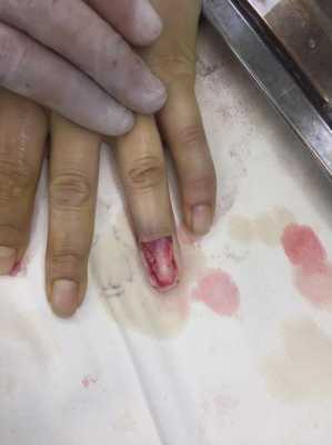 夹伤指甲修复整形手术（指甲夹伤重新长出凹凸不平能修复吗）-图2