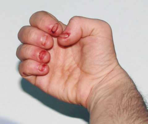 咬指甲治疗方案 严重咬指甲指甲修复-图1