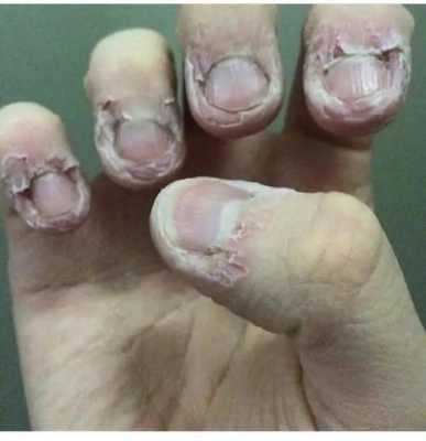 咬指甲治疗方案 严重咬指甲指甲修复-图2